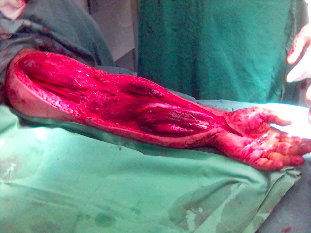 Upper limb fasciotomy